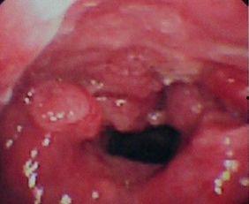 咽喉癌视频,从视频了解关键信息