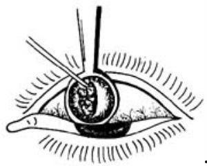 睑板腺囊肿手术视频,睑板腺囊肿手术全过程解析